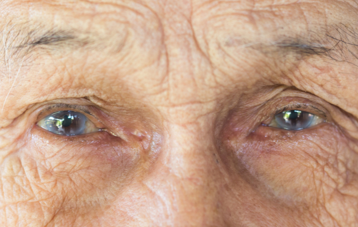 Mild Cataracts Patient